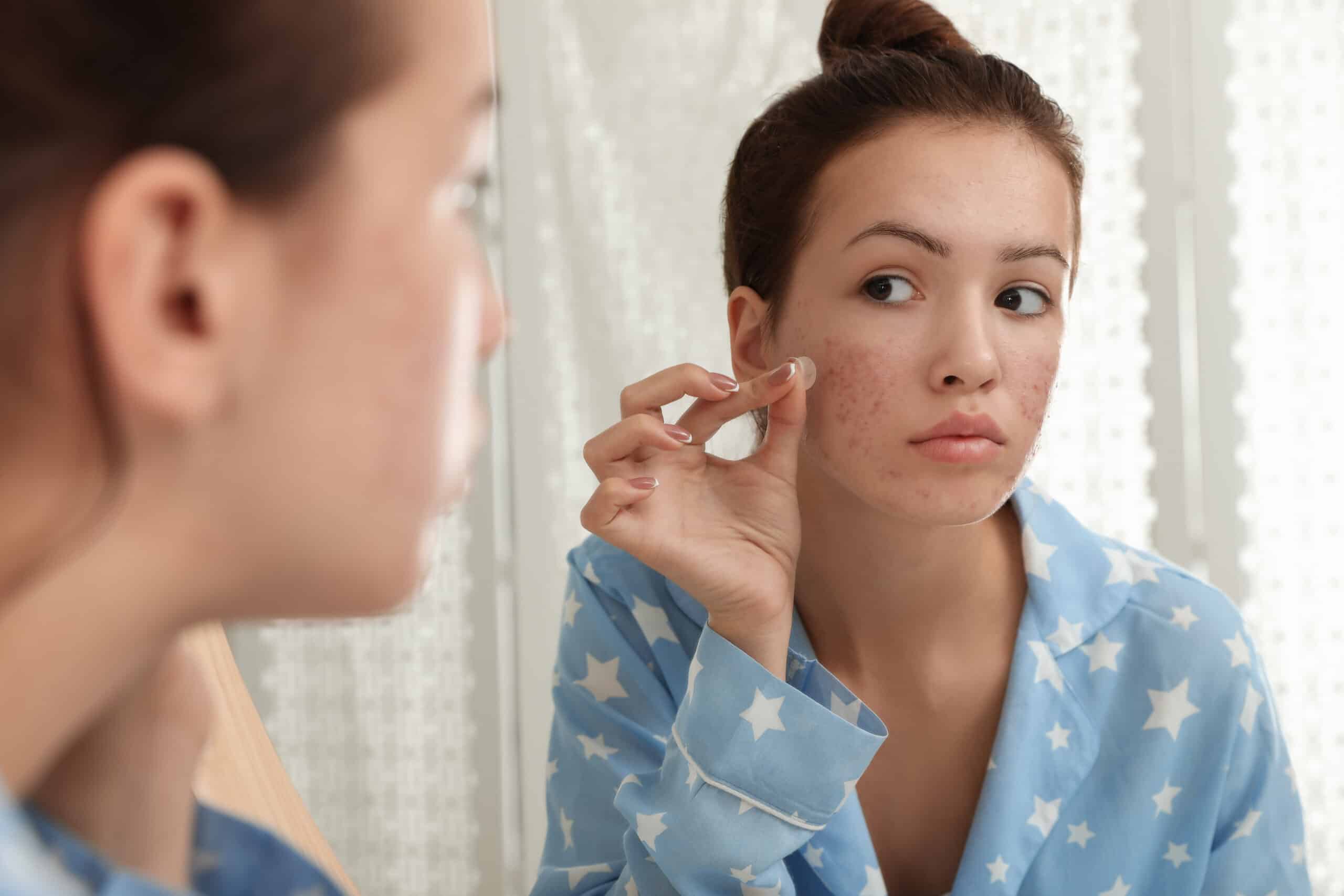 YOUR BEST FOOD CHOICES TO HELP FIGHT TEEN ACNE - Bioteen Health